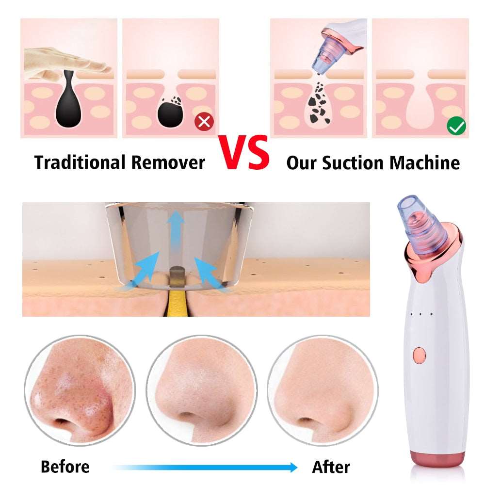 Facial cleansing and acne, blackheads and pimples removal tool